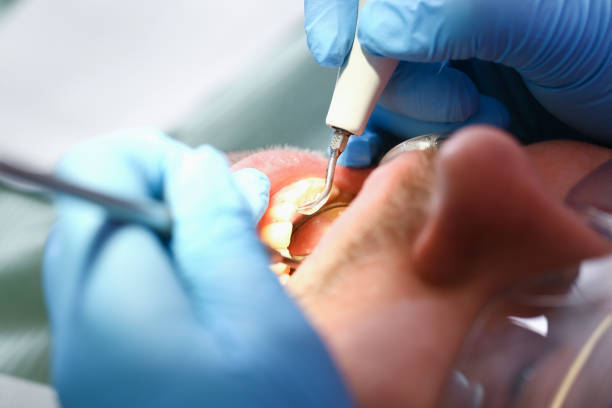 Best Emergency Tooth Extraction in Encantada Ranchito El Calaboz, TX